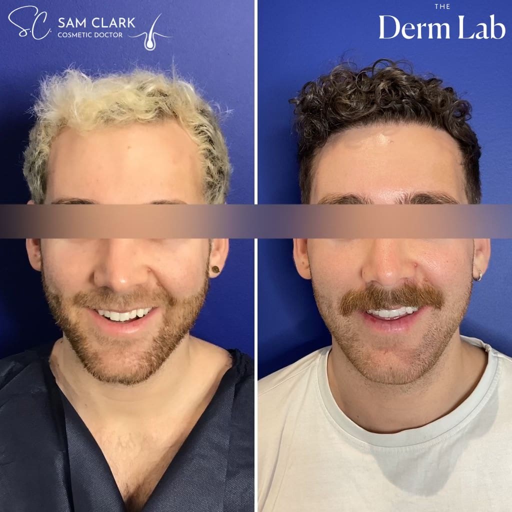 Hair transplant results showing natural hairline design and density after restoration, compared to sparse, thinning hair in the before image.