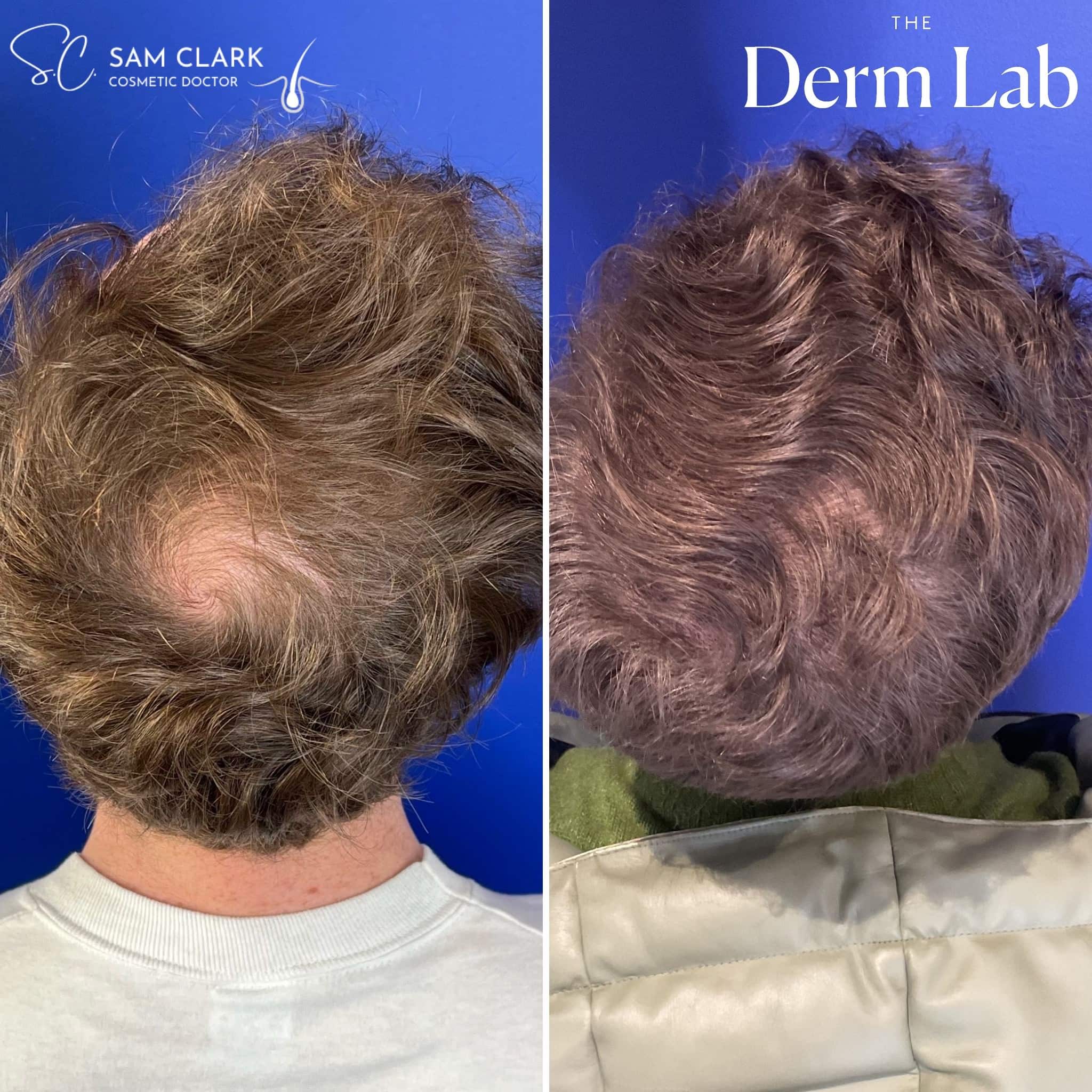 Top-down view before and after hair transplant highlighting regrowth in the crown area, with visible thickening and coverage improvement.