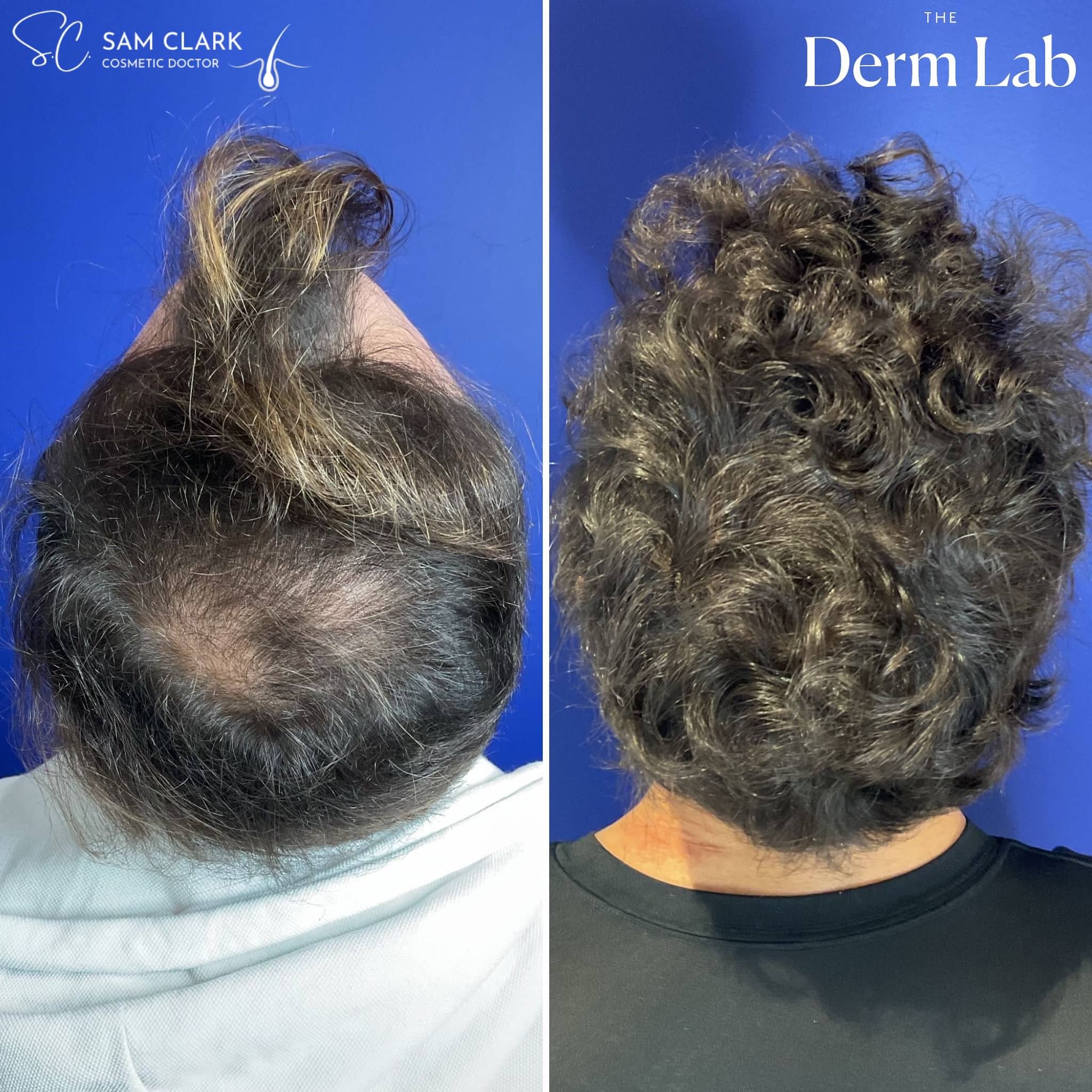 Before and after results of a male hair transplant patient at The Derm Lab Melbourne showing crown and hairline restoration 12 months post-procedure