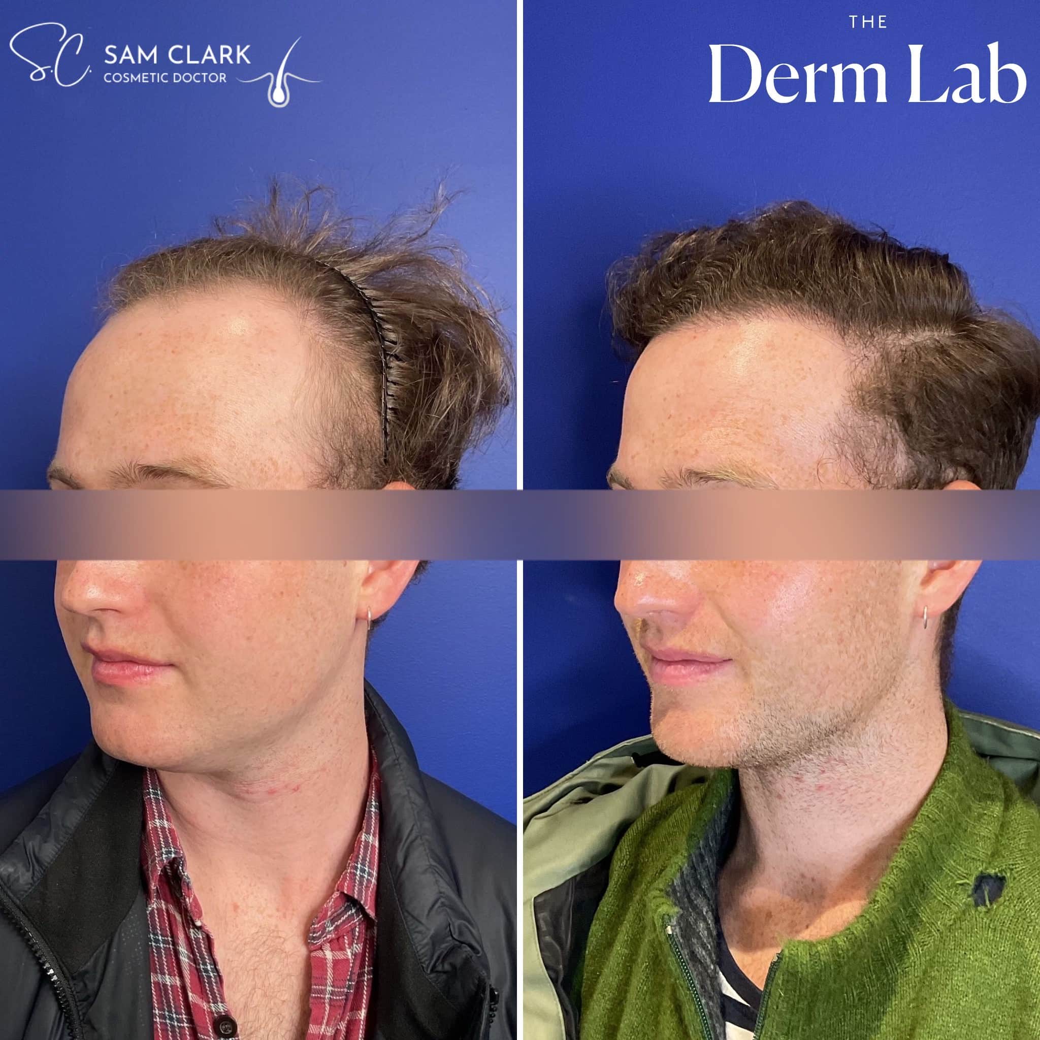 Close-up before and after images of the temples and frontal zone post-hair transplant, showing precise filling and a more youthful hairline.