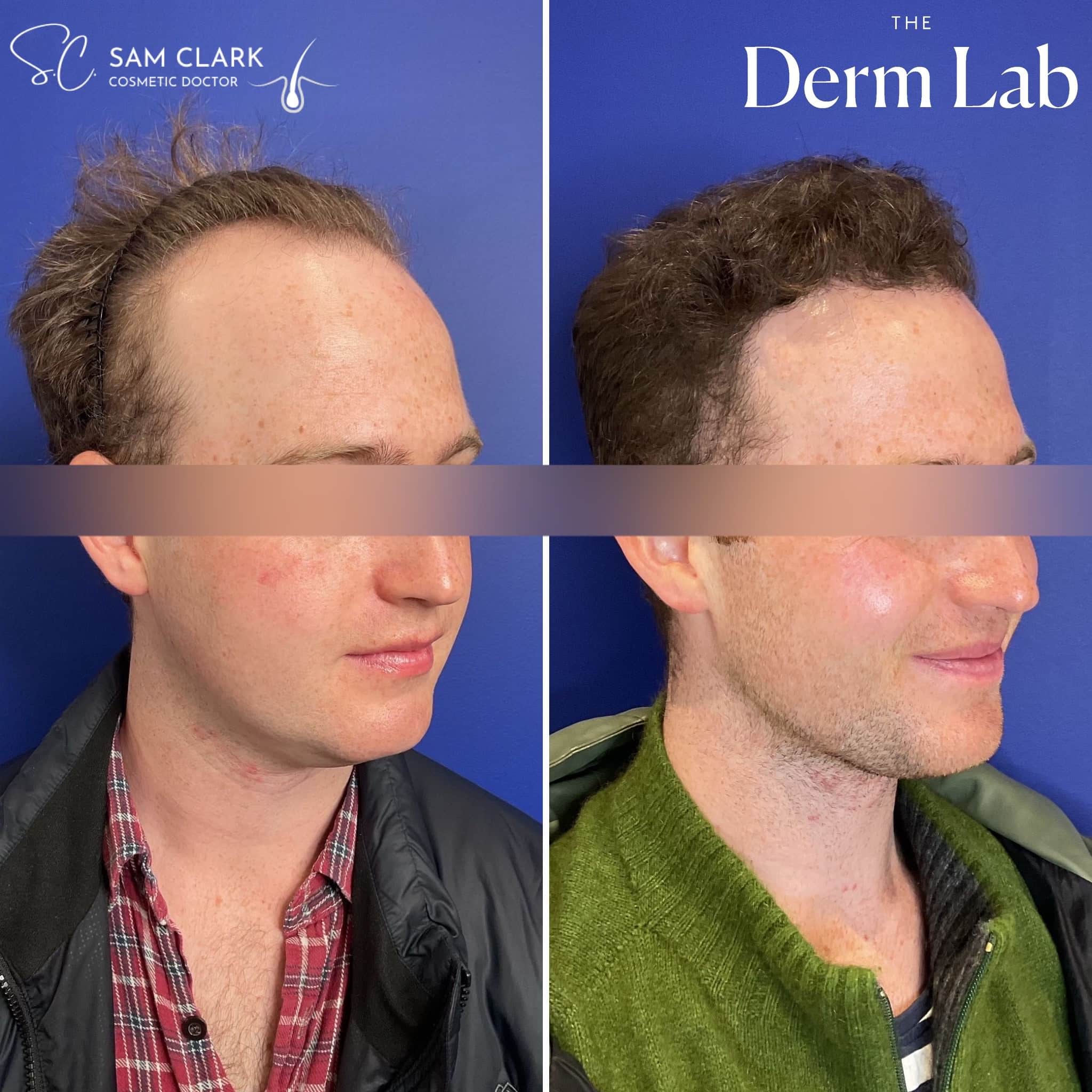 Side-by-side comparison of a male patient with advanced hair loss before transplant and full hair coverage after, demonstrating dramatic transformation.