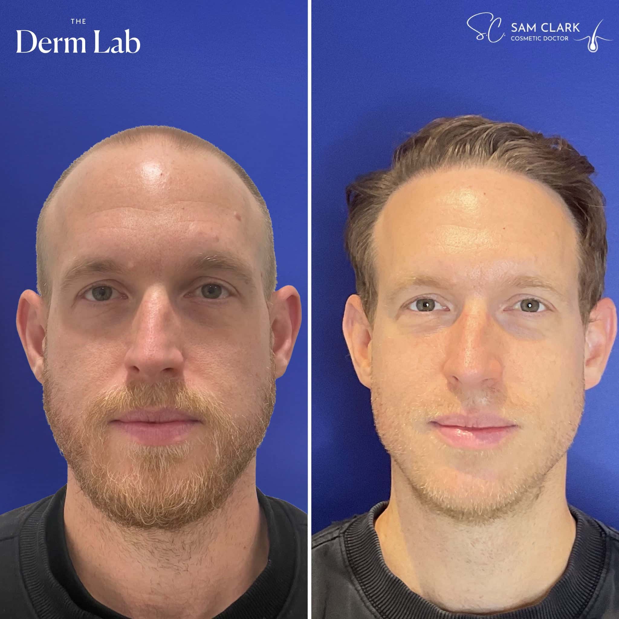 Client showing long-term hair transplant results after FUE procedure at The Derm Lab in Melbourne